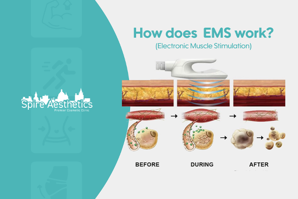 EMS treatment for post pregnancy weight loss treatment Sunbury