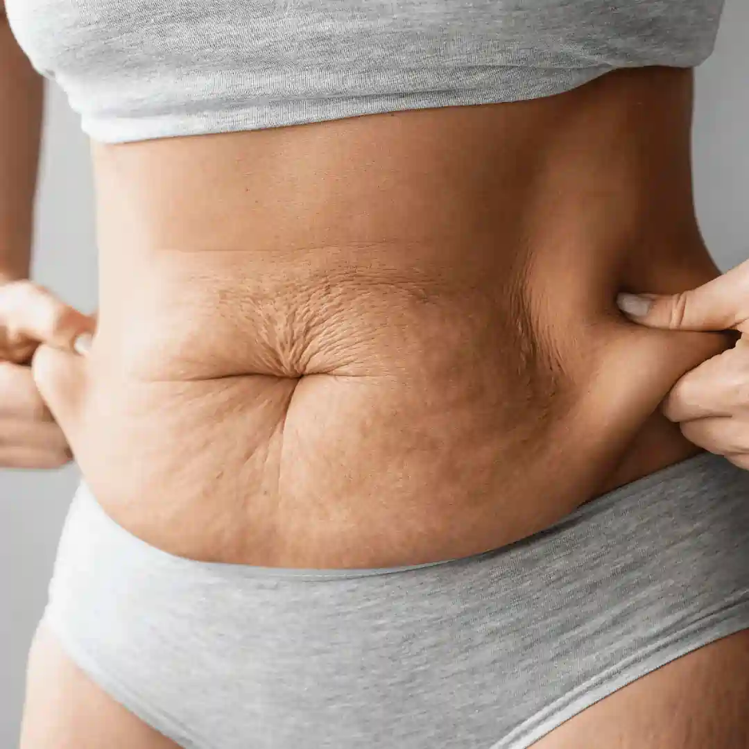 Is It Normal to Have Loose Skin After Pregnancy Sunbury?