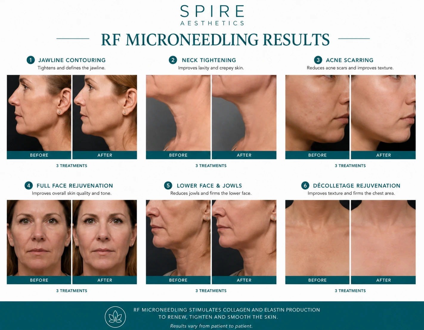 RF Microneedling Skin tightening Sunbury results