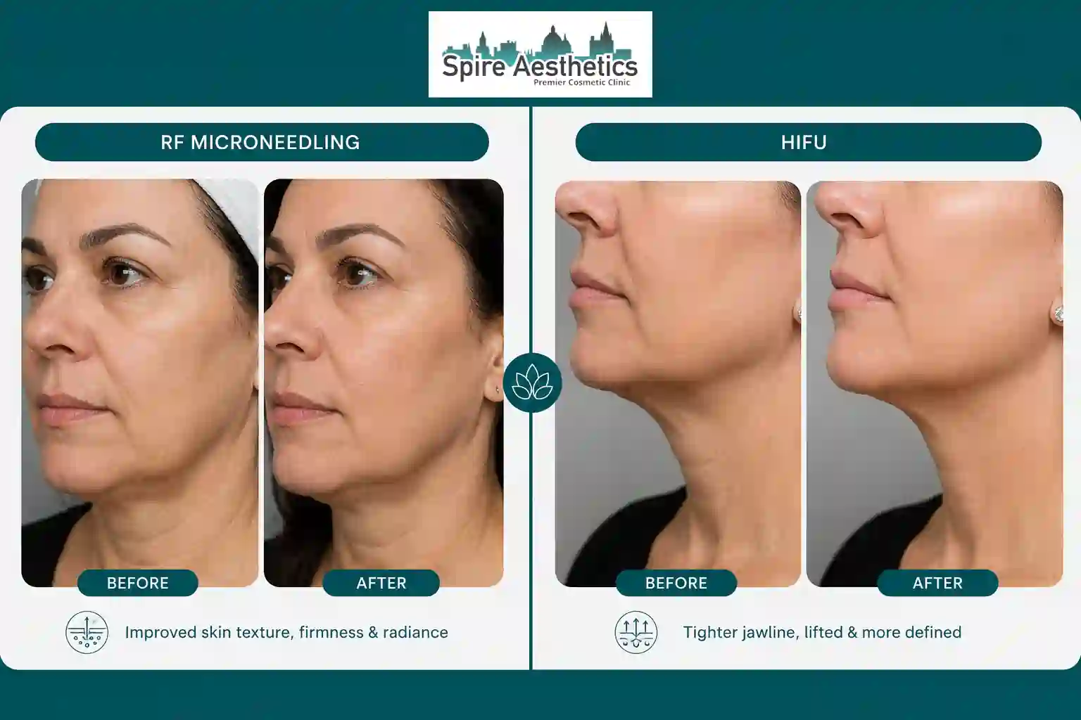 Can RF Microneedling and HIFU Be Combined Sunbury?