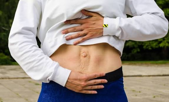 When Could Diastasis Recti Be the Missing Piece of the Puzzle Sunbury?