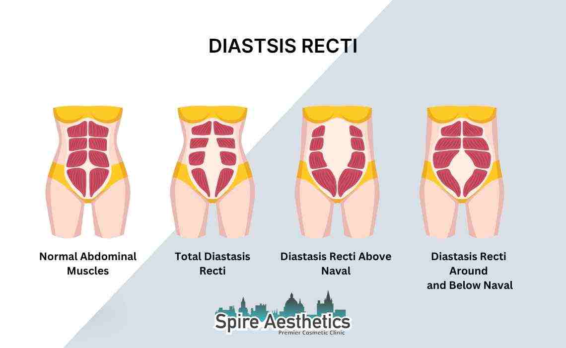 Is Non-Surgical Diastasis Recti Treatment Right for You? Common Concerns Answered Sunbury